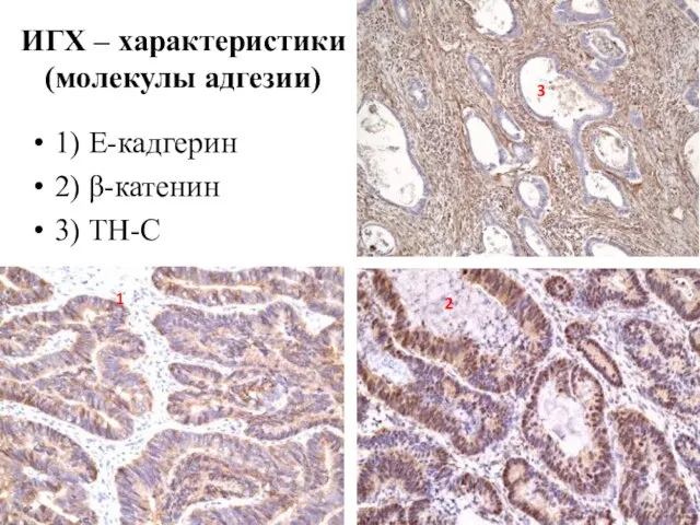 ИГХ – характеристики (молекулы адгезии) 1) E-кадгерин 2) β-катенин 3) ТН-С 1 2 3