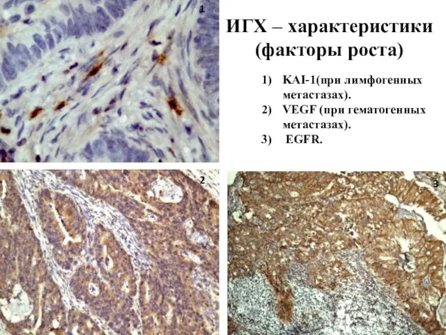 ИГХ – характеристики (факторы роста) KAI-1(при лимфогенных метастазах). VEGF (при гематогенных метастазах). EGFR. 1 3 2