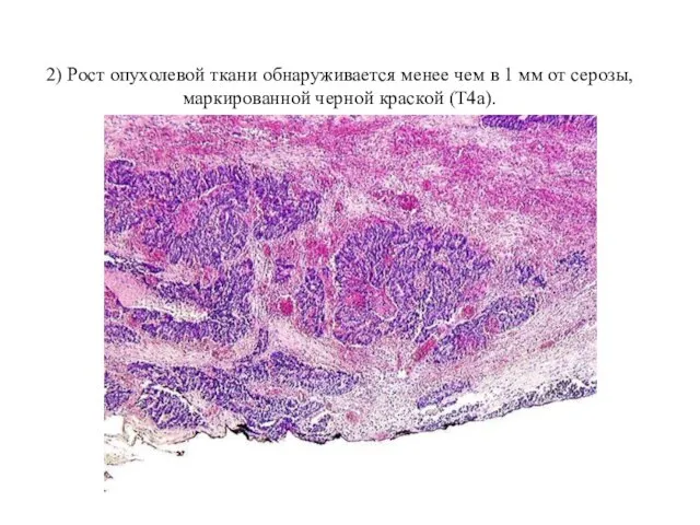2) Рост опухолевой ткани обнаруживается менее чем в 1 мм от серозы, маркированной черной краской (T4a).