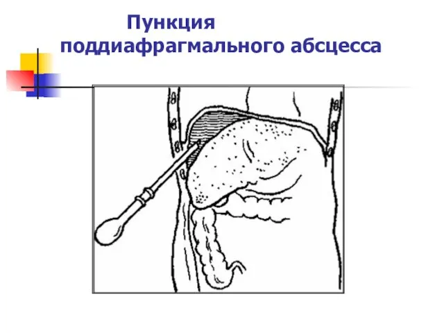 Пункция поддиафрагмального абсцесса