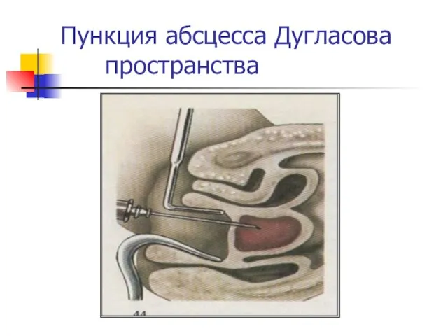 Пункция абсцесса Дугласова пространства