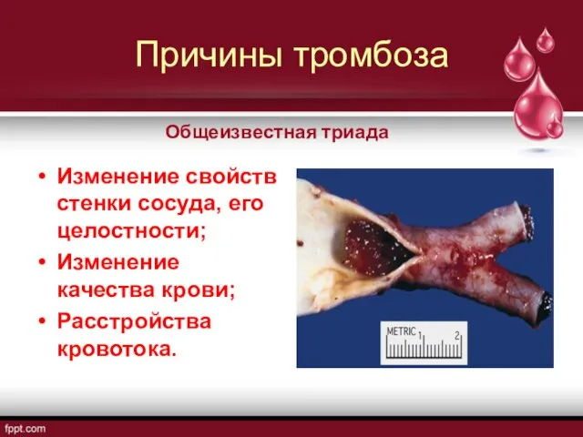 Причины тромбоза Изменение свойств стенки сосуда, его целостности; Изменение качества крови; Расстройства кровотока. Общеизвестная триада