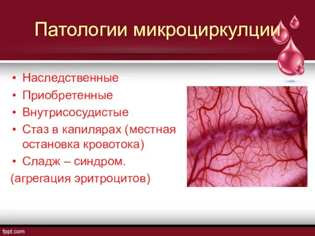 Патологии микроциркулции Наследственные Приобретенные Внутрисосудистые Стаз в капилярах (местная остановка кровотока) Сладж – синдром. (агрегация эритроцитов)