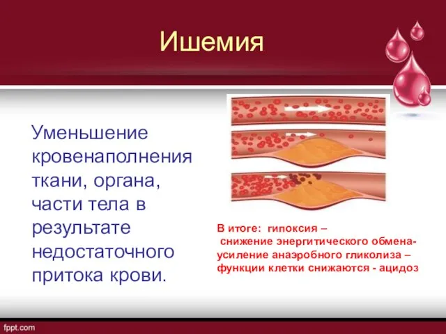 Ишемия Уменьшение кровенаполнения ткани, органа, части тела в результате недостаточного притока