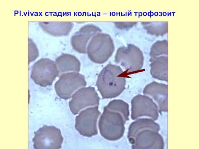 Pl.vivax стадия кольца – юный трофозоит