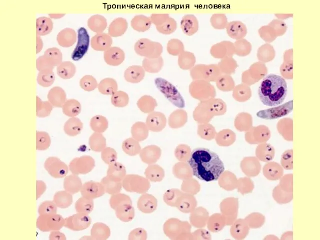 Тропическая малярия человека