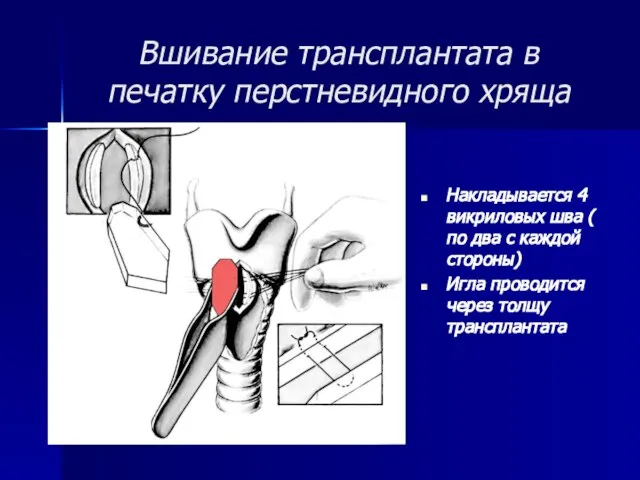 Вшивание трансплантата в печатку перстневидного хряща Накладывается 4 викриловых шва (