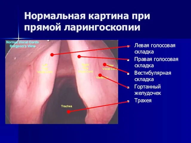 Нормальная картина при прямой ларингоскопии Левая голосовая складка Правая голосовая складка Вестибулярная складка Гортанный желудочек Трахея