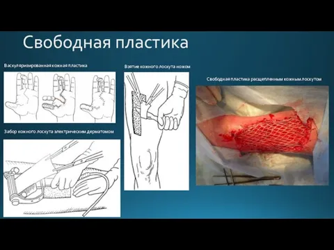 Свободная пластика Васкуляризированная кожная пластика Взятие кожного лоскута ножом Забор кожного