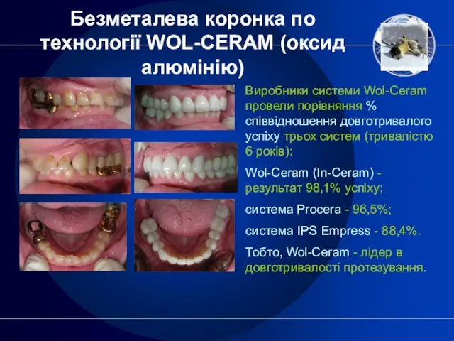 Безметалева коронка по технології WOL-CERAM (оксид алюмінію) Виробники системи Wol-Ceram провели