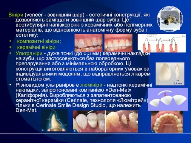 Вініри (veneer - зовнішній шар) - естетичні конструкції, які дозволяють заміщати