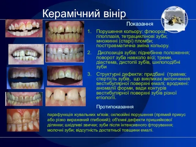 Керамічний вінір Показання Порушення кольору: флюороз; гіпоплазія, тетрациклінові зуби; множинні (старі)