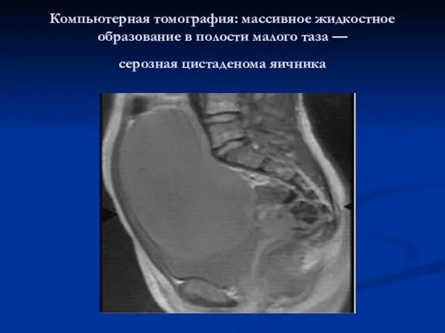 Компьютерная томография: массивное жидкостное образование в полости малого таза — серозная цистаденома яичника