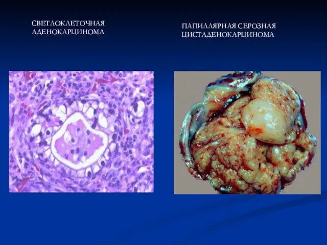СВЕТЛОКЛЕТОЧНАЯ АДЕНОКАРЦИНОМА ПАПИЛЛЯРНАЯ СЕРОЗНАЯ ЦИСТАДЕНОКАРЦИНОМА