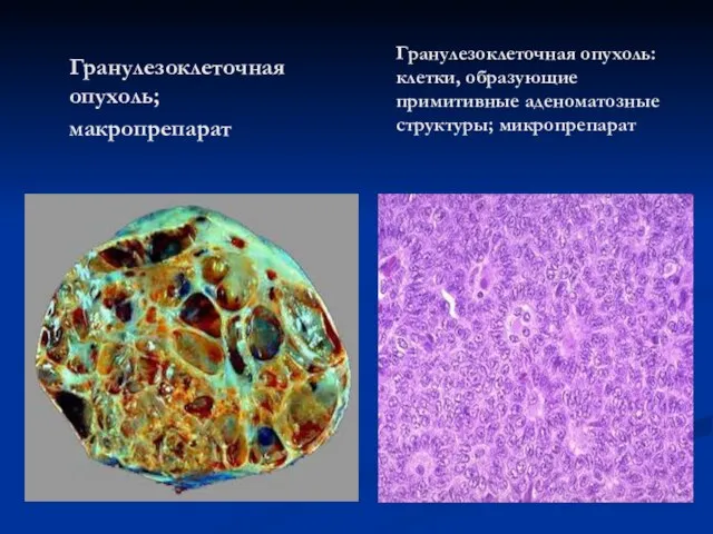 Гранулезоклеточная опухоль; макропрепарат Гранулезоклеточная опухоль: клетки, образующие примитивные аденоматозные структуры; микропрепарат