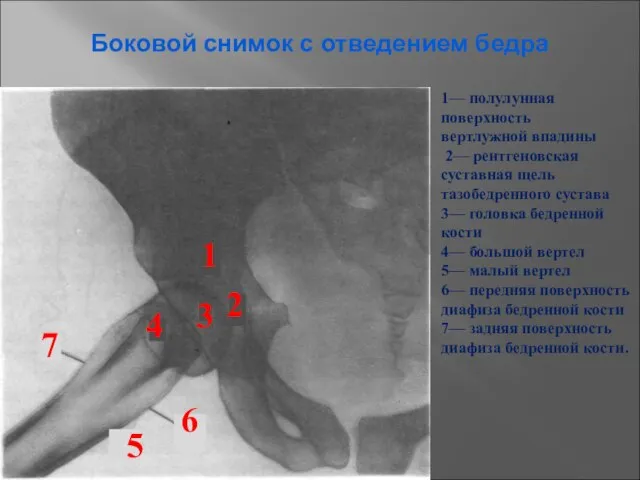 1— полулунная поверхность вертлужной впадины 2— рентгеновская суставная щель тазобедренного сустава