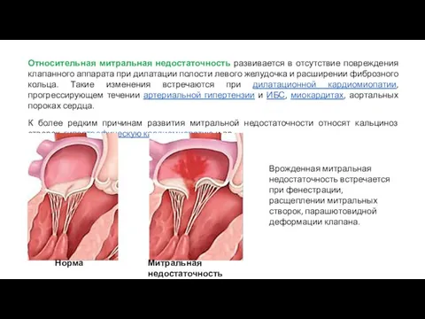 Относительная митральная недостаточность развивается в отсутствие повреждения клапанного аппарата при дилатации