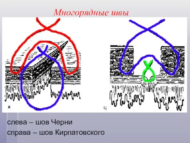 Многорядные швы слева – шов Черни справа – шов Кирпатовского