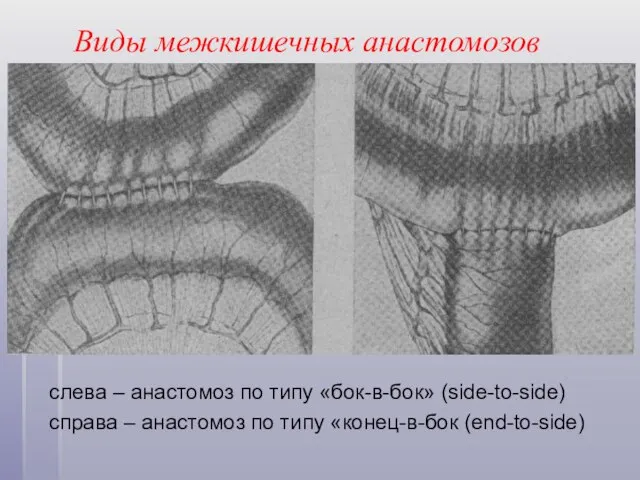Виды межкишечных анастомозов слева – анастомоз по типу «бок-в-бок» (side-to-side) справа
