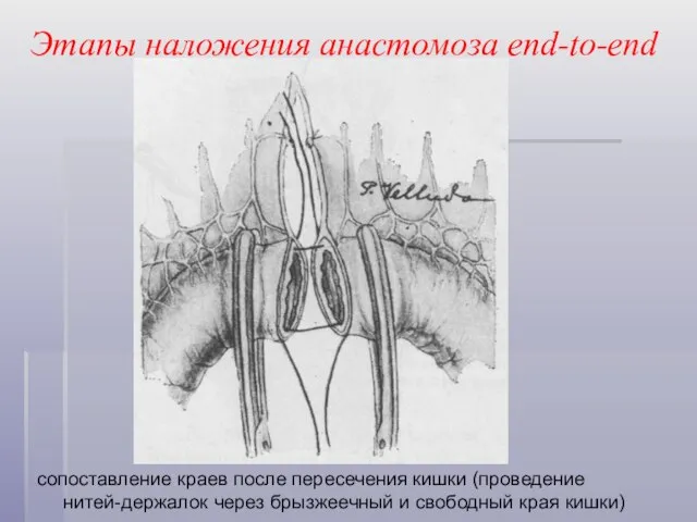 Этапы наложения анастомоза end-to-end сопоставление краев после пересечения кишки (проведение нитей-держалок