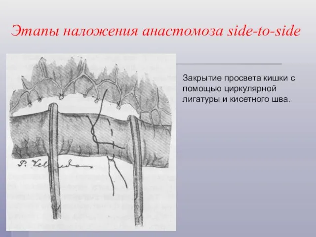 Этапы наложения анастомоза side-to-side Закрытие просвета кишки с помощью циркулярной лигатуры и кисетного шва.