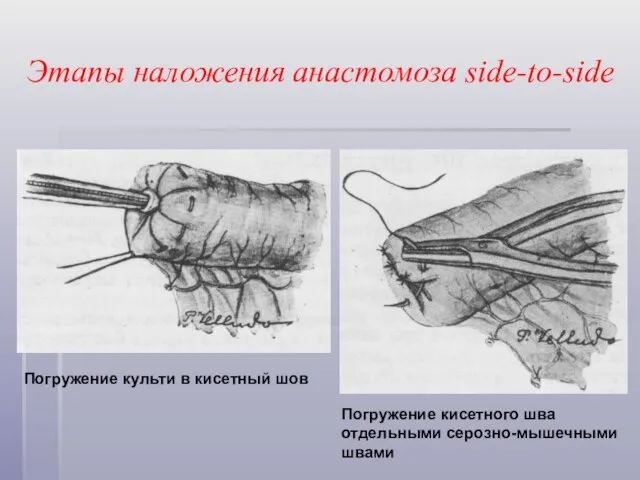 Этапы наложения анастомоза side-to-side Погружение кисетного шва отдельными серозно-мышечными швами Погружение культи в кисетный шов