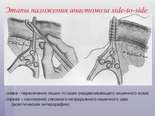 Этапы наложения анастомоза side-to-side слева - пересечение кишки по краю раздавливающего