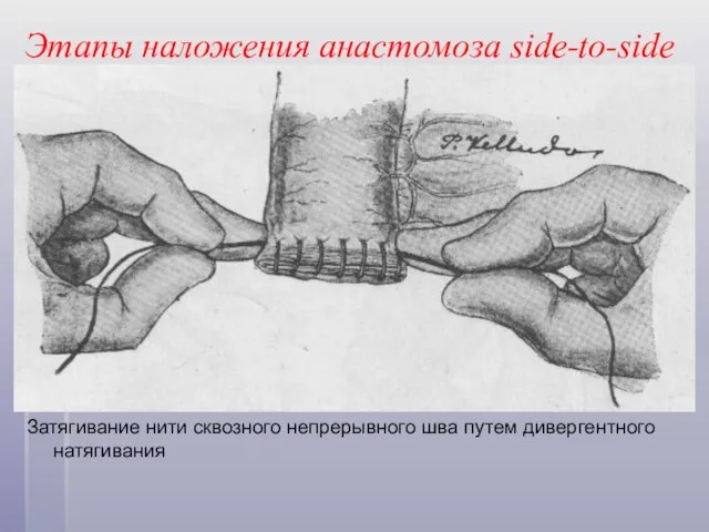 Этапы наложения анастомоза side-to-side Затягивание нити сквозного непрерывного шва путем дивергентного натягивания