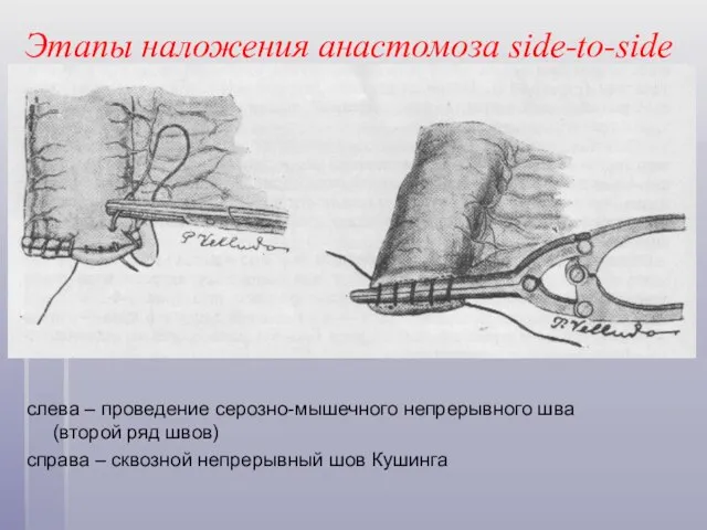 Этапы наложения анастомоза side-to-side слева – проведение серозно-мышечного непрерывного шва (второй