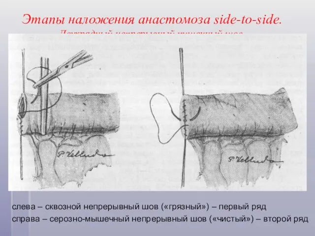 Этапы наложения анастомоза side-to-side. Двухрядный непрерывный кишечный шов. слева – сквозной