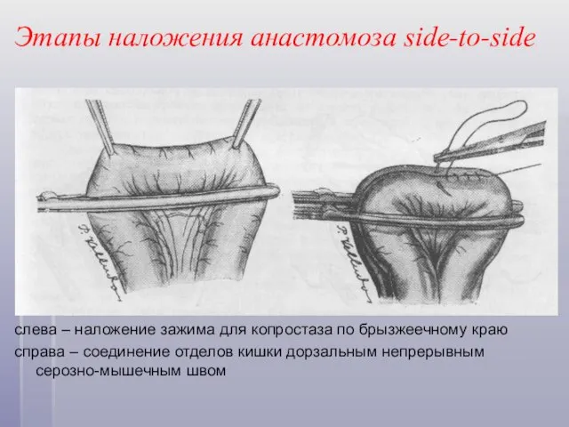 Этапы наложения анастомоза side-to-side слева – наложение зажима для копростаза по