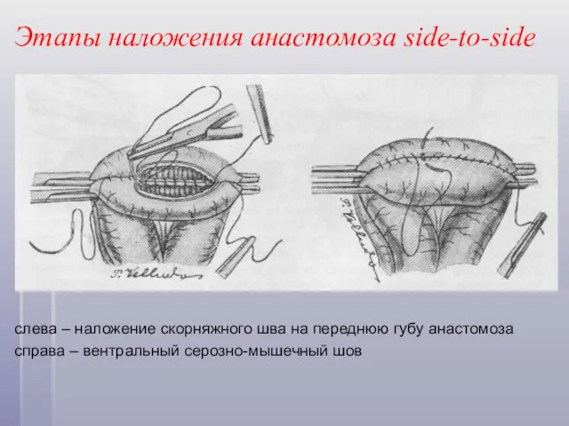 Этапы наложения анастомоза side-to-side слева – наложение скорняжного шва на переднюю