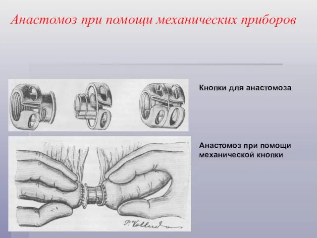 Анастомоз при помощи механических приборов Кнопки для анастомоза Анастомоз при помощи механической кнопки