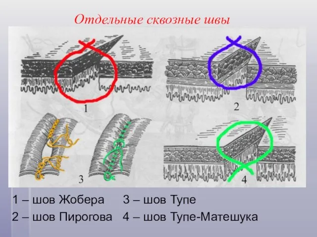 Отдельные сквозные швы 1 – шов Жобера 3 – шов Тупе