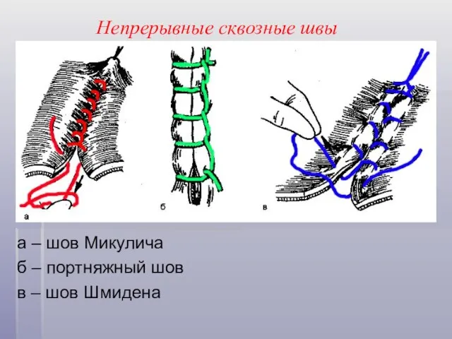 Непрерывные сквозные швы а – шов Микулича б – портняжный шов в – шов Шмидена