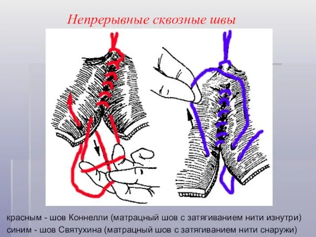 Непрерывные сквозные швы красным - шов Коннелли (матрацный шов с затягиванием