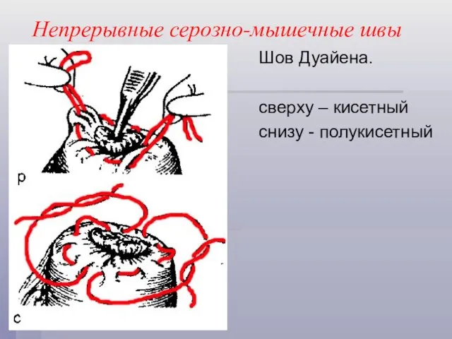 Непрерывные серозно-мышечные швы Шов Дуайена. сверху – кисетный снизу - полукисетный