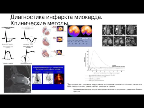 Диагностика инфаркта миокарда. Клинические методы.