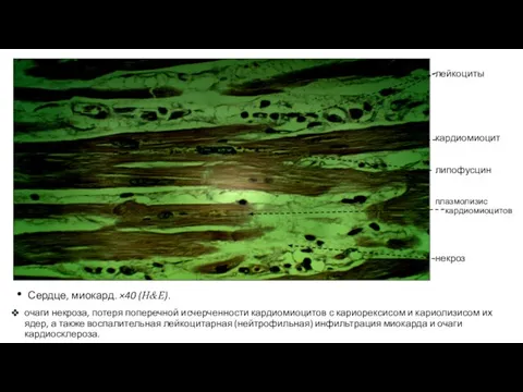 Сердце, миокард. ×40 (H&E). очаги некроза, потеря поперечной исчерченности кардиомиоцитов с