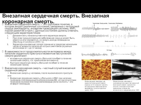 Внезапная сердечная смерть. Внезапная коронарная смерть. Внезапная сердечная смерть — это