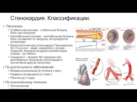 Стенокардия. Классификации. Патогенез: Стабильная (основа – стабильная бляшка, боль при нагрузке)