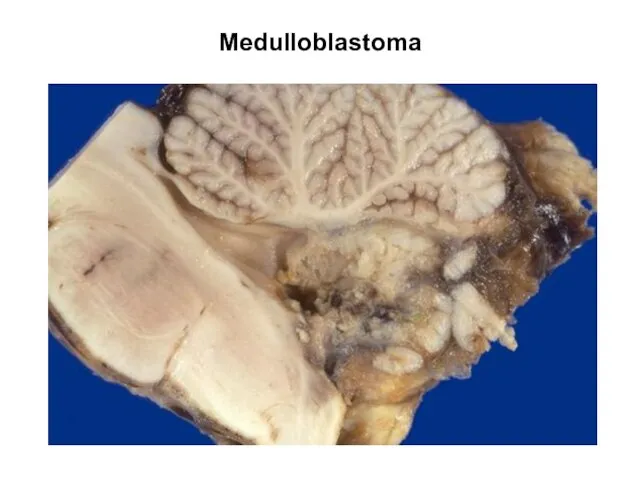 Medulloblastoma