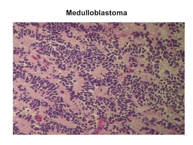 Medulloblastoma