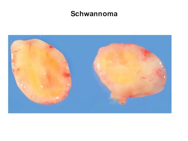 Schwannoma