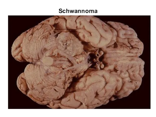 Schwannoma