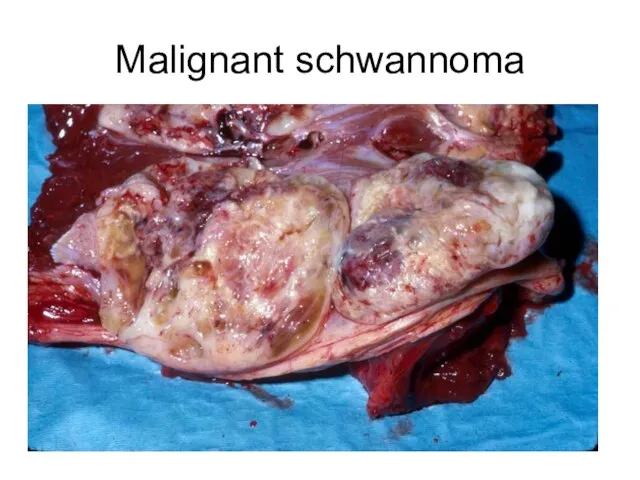 Malignant schwannoma