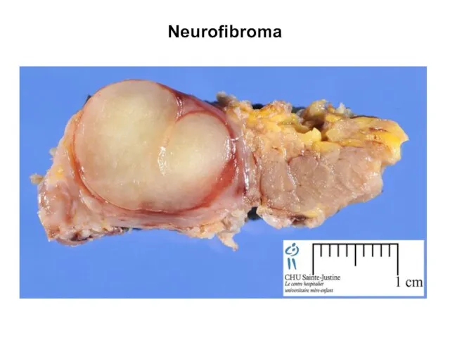 Neurofibroma