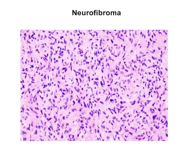 Neurofibroma