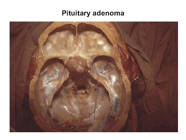 Pituitary adenoma