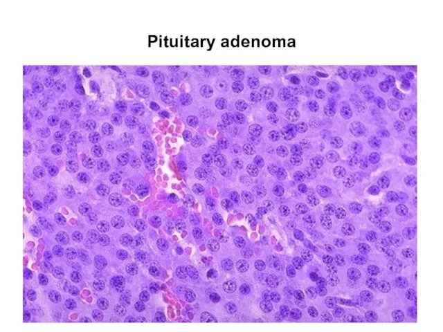 Pituitary adenoma